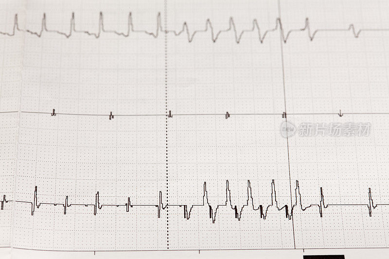 心电图(ECG)