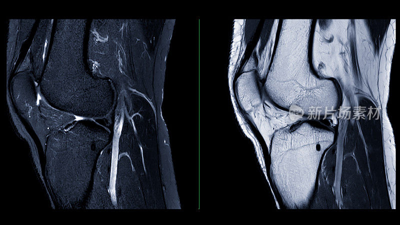 膝关节的磁共振成像或MRI。这种诊断技术对于评估韧带、软骨和识别撕裂或炎症等问题至关重要。