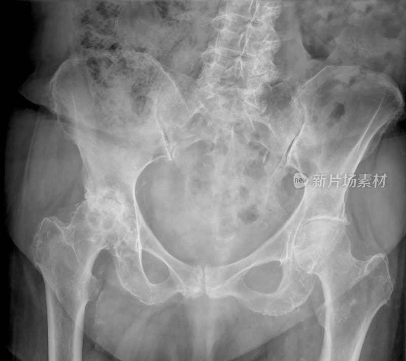 x光片显示右髋关节有严重的骨关节炎