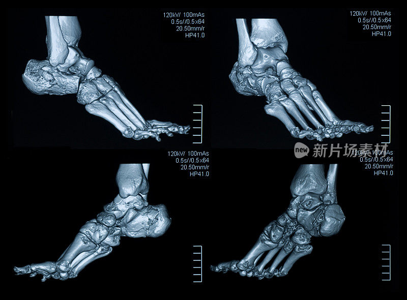 脚的CAT扫描图像