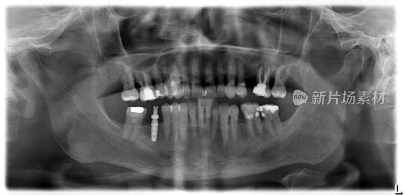 牙科x光1