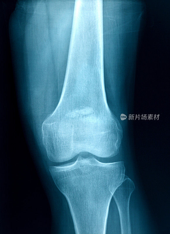 膝关节x光骨人类腿部解剖学