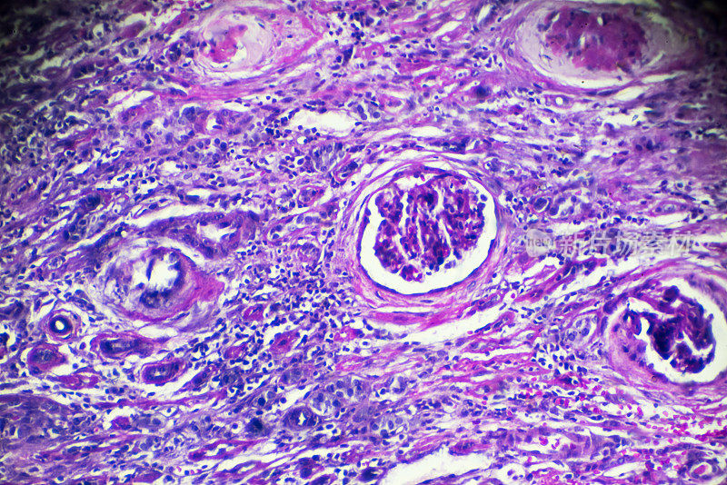 新月体肾小球肾炎活检标本