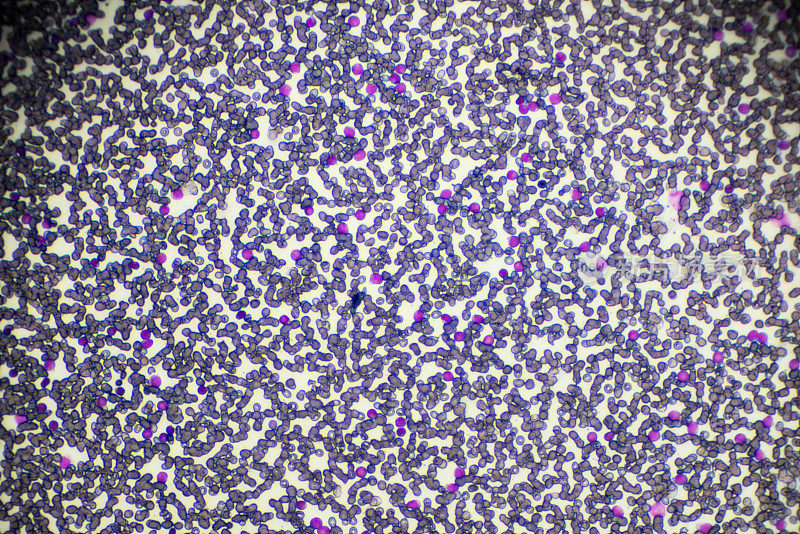光镜下急性淋巴母细胞白血病ALL-L3血液涂片