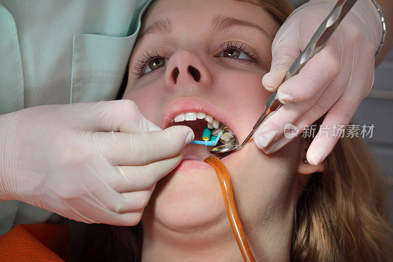 牙科手术，补牙