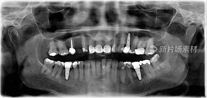 牙科x光检查含种植体的牙齿