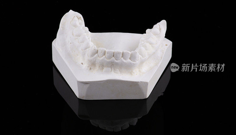 模型上的蜡模牙冠，无金属正面视图。陶瓷正面贴面孤立在黑色背景上。牙科实验室石膏模型上的金属-陶瓷冠。