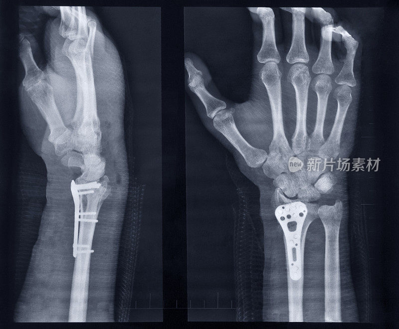 手腕骨折术后x光片