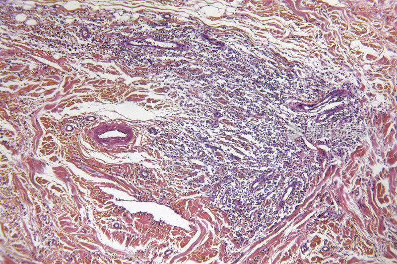 乳腺肥大细胞瘤