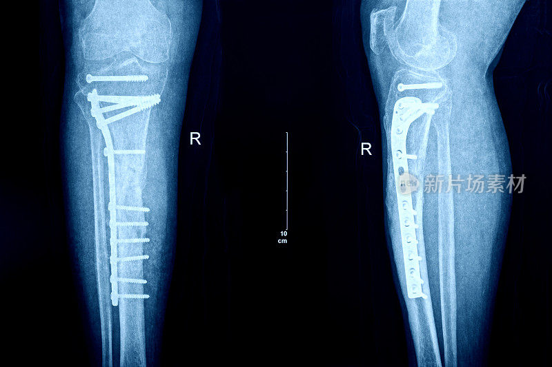 骨折腿的x线照片与骨合成材料