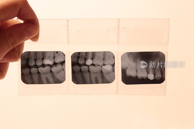 牙医牙齿放射照相