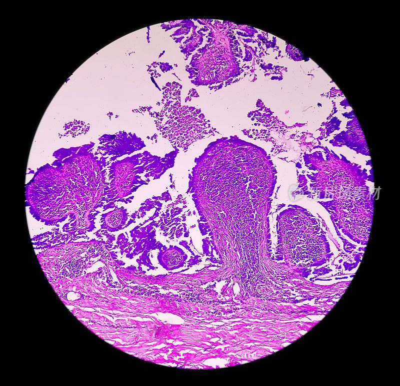 子宫内膜癌意识:子宫活检显微照片显示子宫内膜癌或子宫内膜癌。