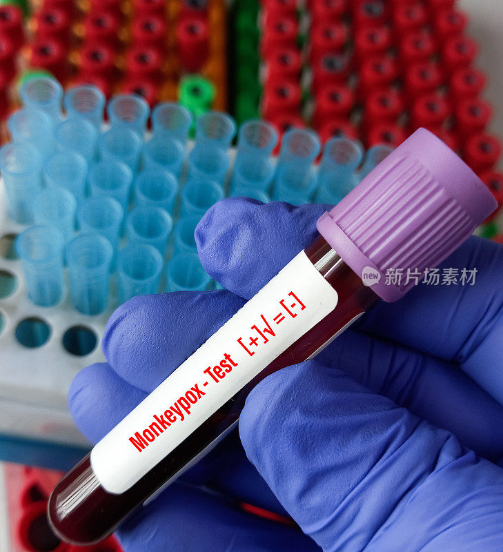 猴痘病毒检测用血样管。它是一种双链DNA、人畜共患病的病毒，是痘病毒科正痘病毒属的一种。