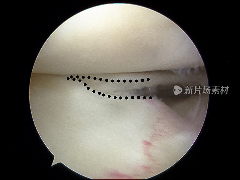 外侧半月板桡骨撕裂的关节镜观察