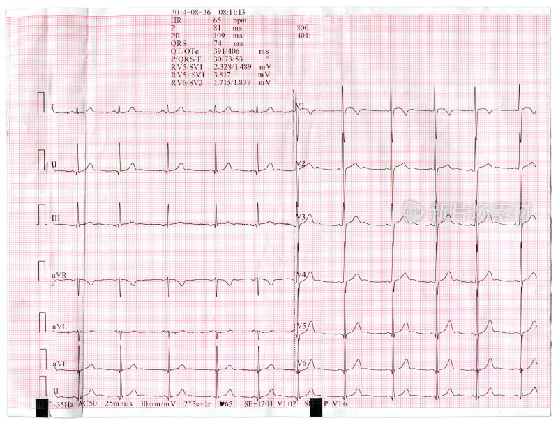 心脏在纸上的心电图
