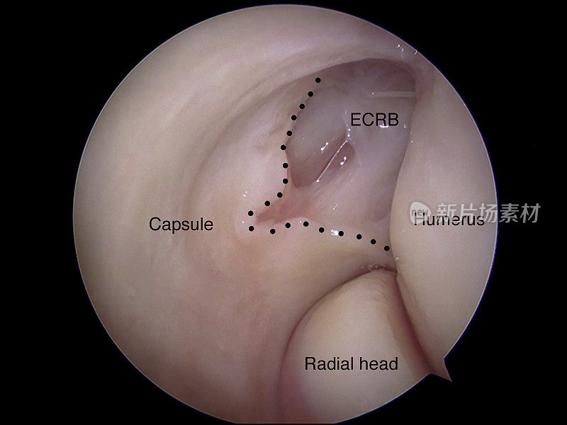 网球肘典型病理的关节镜观察