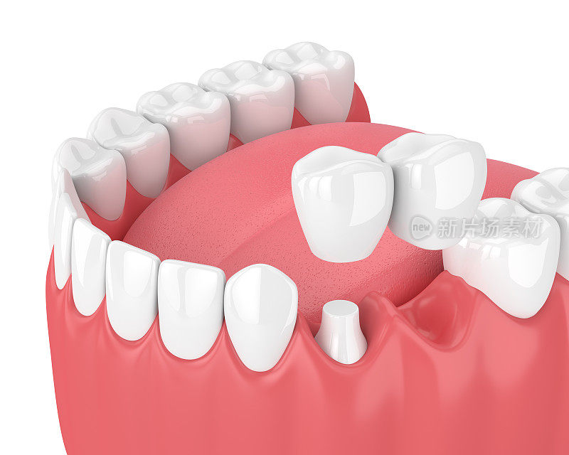 3d渲染颌骨与牙科悬臂桥