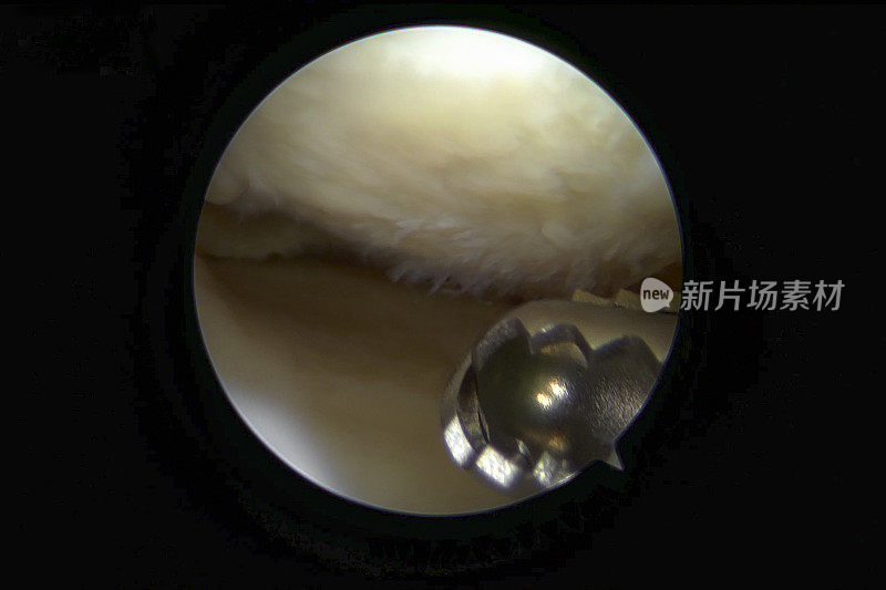 患有轻度至中度骨关节炎的人右膝内侧腔室的关节镜视图