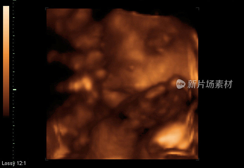 胎儿宝宝超声波屏幕截图