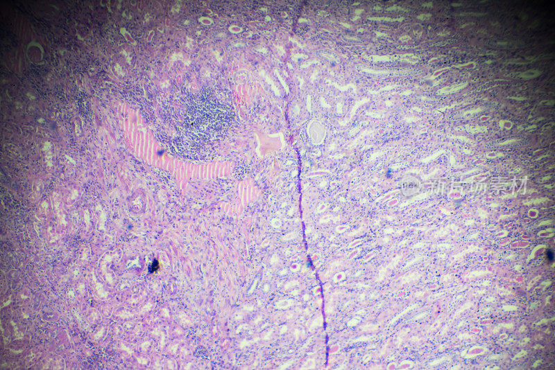 光镜下慢性肾盂肾炎活检