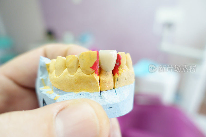 特写陶瓷牙冠在石膏模型的牙齿在牙医的手
