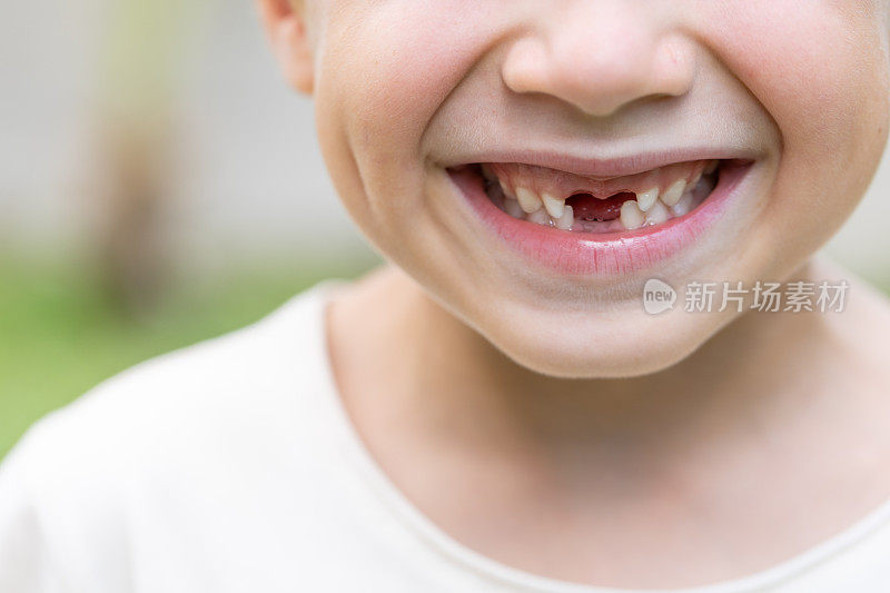 特写照片微笑的学龄缺口牙齿的男孩少了四颗门牙
