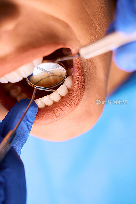 牙医在牙科诊所检查一名妇女的牙齿。