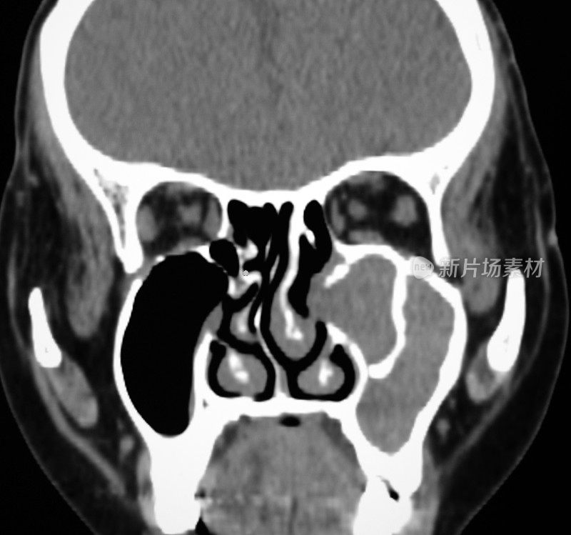 冠状位CT显示鼻窦肿瘤