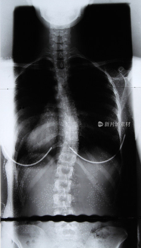 女性脊柱x光片