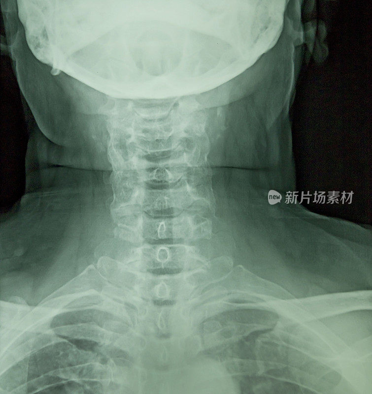 人颈部x光片