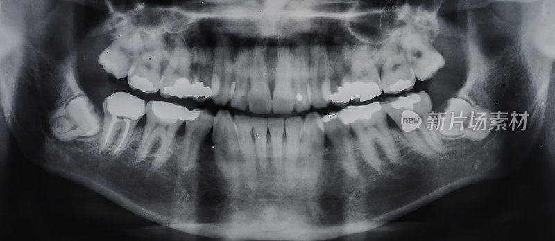 人类的智齿是常见的四颗第三臼齿中的任何一颗。智齿可以发育，形成阻生或“向侧面生长”。第三磨牙或窗牙深深阻生。