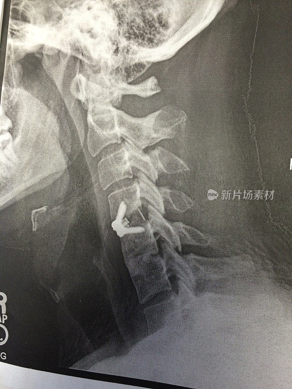 颈椎内固定螺钉融合术