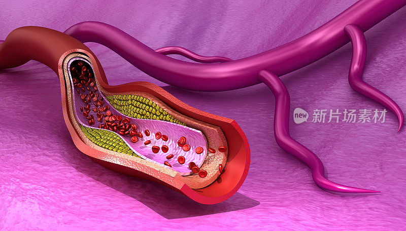 血管中的胆固醇斑块，医学上精确的3D插图