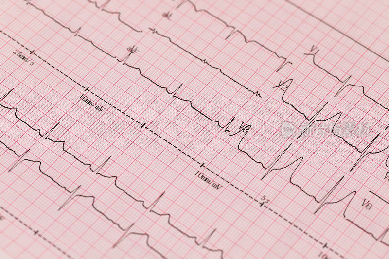 心电图