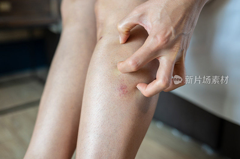 女人抓挠大腿上的红疹(或淤青)的特写。