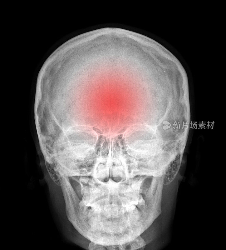 x光片-颅骨红色表示疼痛部位