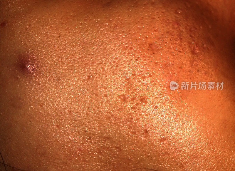 脸上有丘疹和痤疮的发炎皮肤。痤疮造成的疤痕