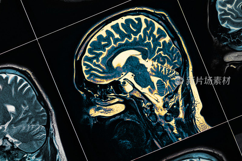 病人头部的MRI特写。系列中的一张图片