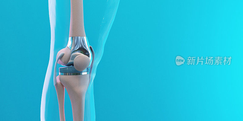 膝关节置换