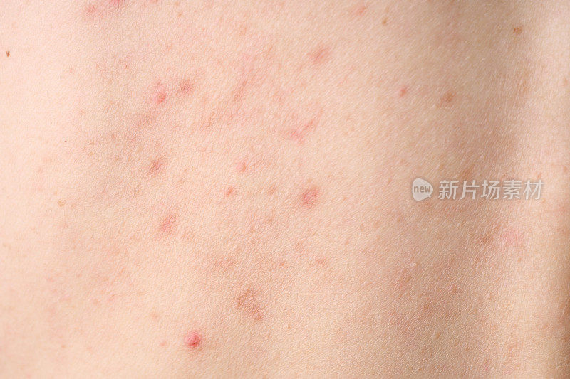 皮肤有痘痘，有红斑。健康问题，皮肤病。过敏皮疹。皮疹的皮炎问题。