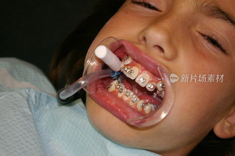 小女孩的牙齿上有支架-特写