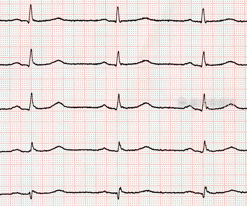 心电图显示心脏活动正常