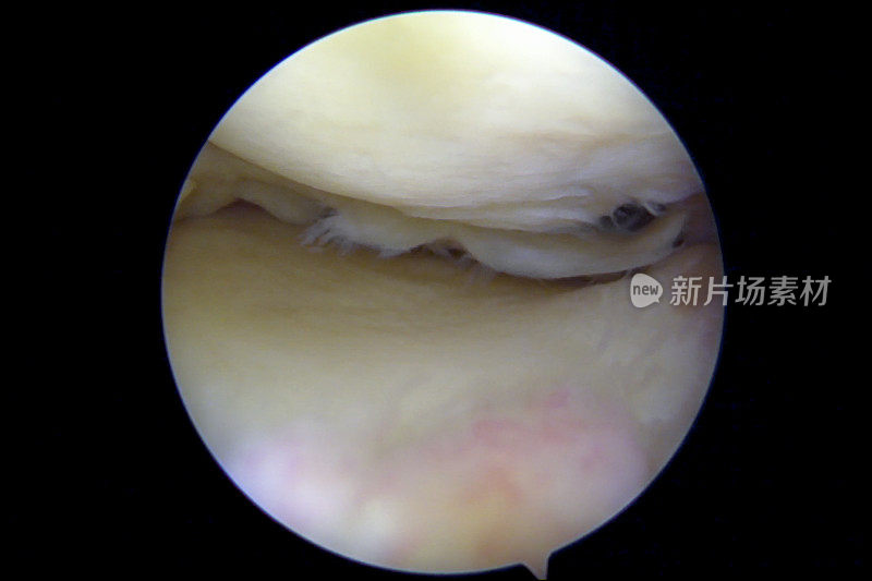 膝关节镜检查显示半月板撕裂和关节软骨损伤