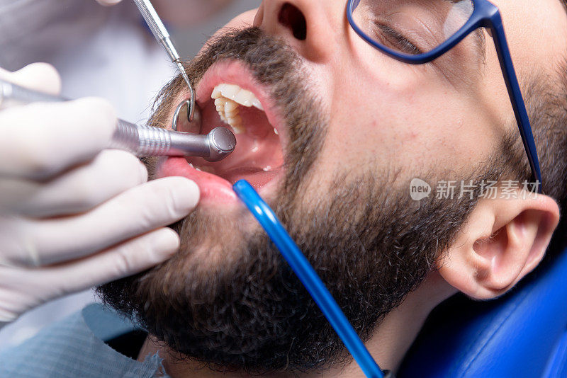 牙医用涡轮钻牙。唾液喷射器被放置在病人的嘴里