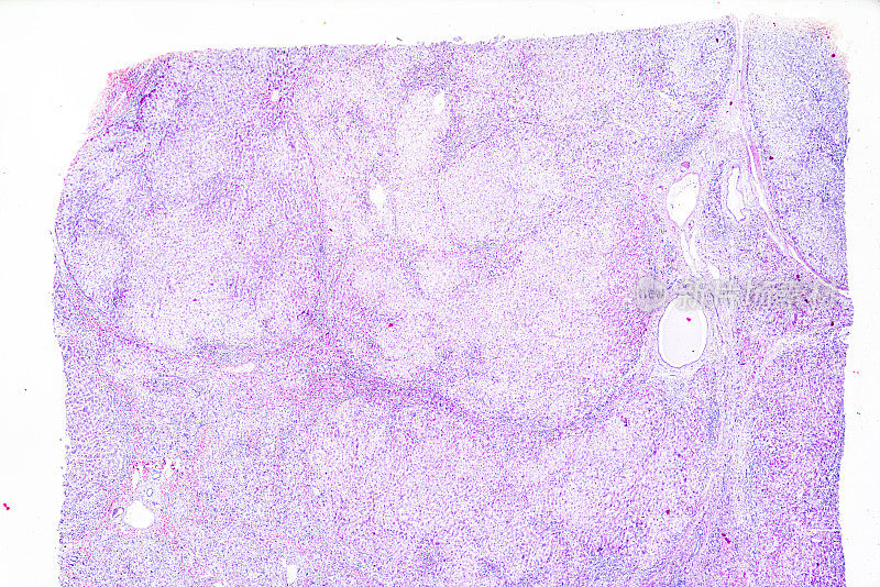 显微镜下人类局灶性结节性肝硬化病理标本