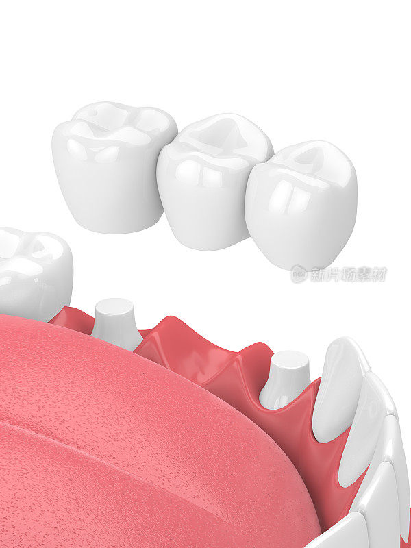 颌骨的3d渲染与牙科桥