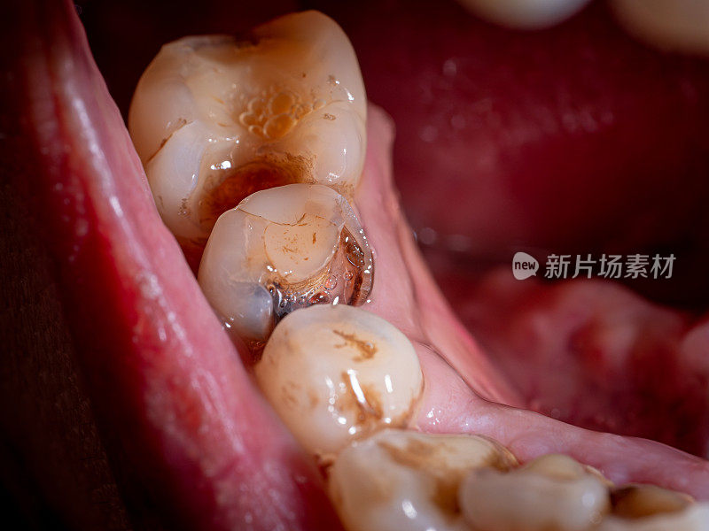 蛀牙，碎牙，口腔健康牙齿健康状况不佳。口腔健康问题。牙齿松动、发黄，牙龈边缘有牙菌斑和牙垢