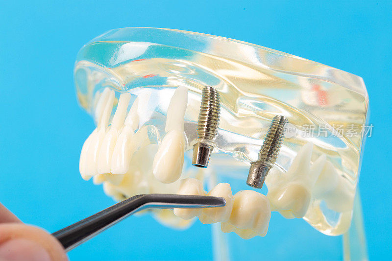 牙桥在镊子对背景医学模型的牙颌，特写。正畸学和牙科中的牙修复学。现代技术。文本复制空间