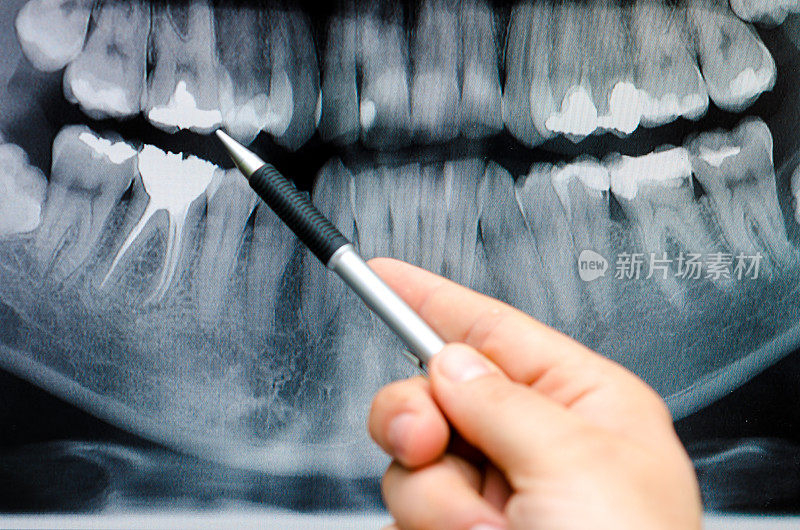 牙科医生在牙科x光图像上显示了一些东西
