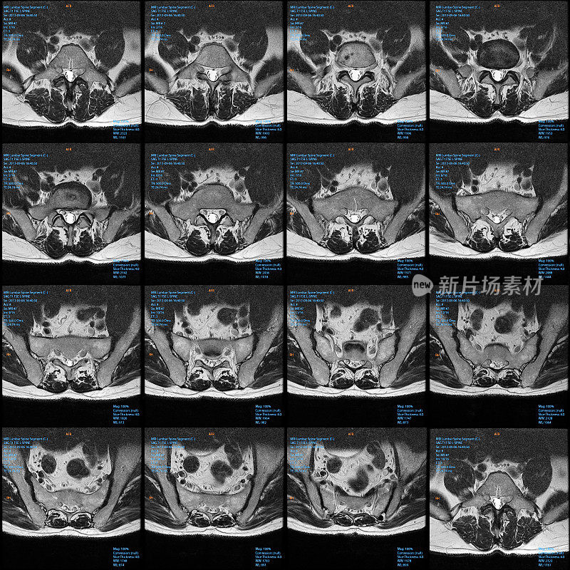 腰椎(脊柱)MRI横切面切片